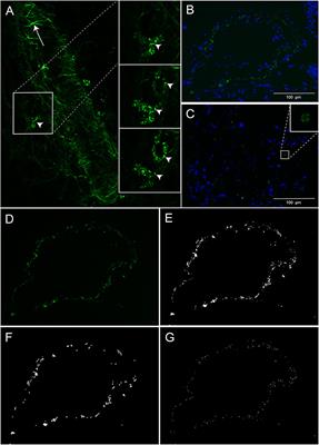 Cholesterol Crystals and NLRP3 Mediated Inflammation in the Uterine Wall Decidua in Normal and Preeclamptic Pregnancies